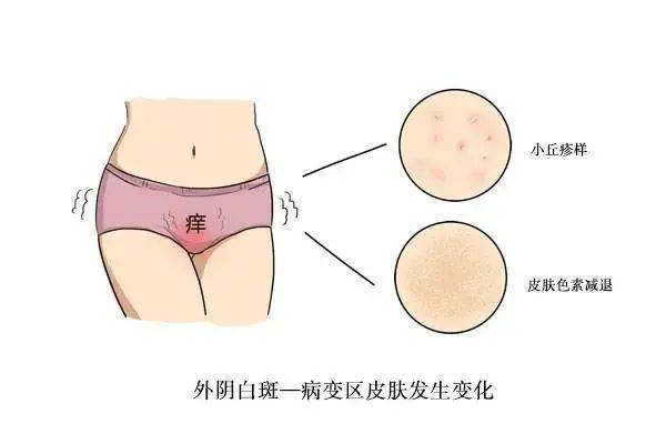 外阴白斑癌变的表现有哪些？